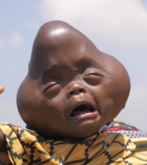 Filho-Bebê-Ruanda-bebê deformado