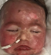 Bebê-Reação alérgica-Rosto
