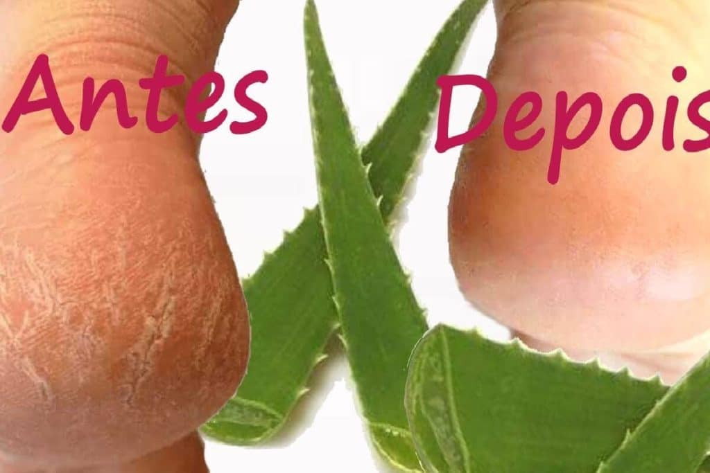 Como Tirar Rachaduras Dos Pés