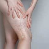 Número De Casos De Trombose Venosa Está Em Alta No Brasil