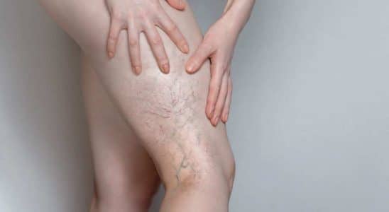 Número De Casos De Trombose Venosa Está Em Alta No Brasil