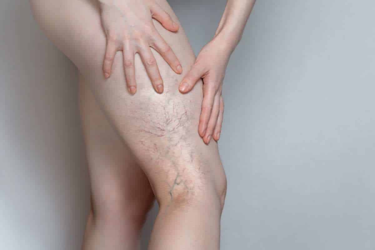 Número De Casos De Trombose Venosa Está Em Alta No Brasil