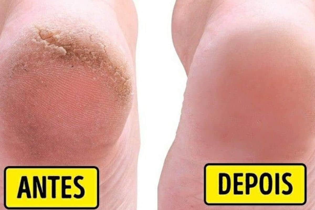 Dica para pés rachados e ressecados ficarem lisinhos e macios