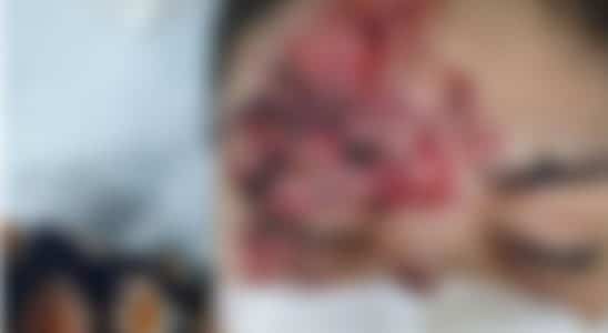 Homem Tem Rosto Desfigurado Com Golpes De Faca Em Briga De Bar Em Alumínio