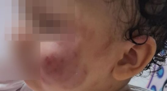 Professora É Afastada De Creche Em Carapicuíba Após Bebê Volta Para Casa Com Mordidas 10 Bebê-Mordida-Professora-Creche-Carapicuiba