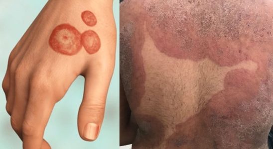 Super Vírus Resistente A Tratamento Que Causa Infecções Na Pele É Registrado No Interior De Sp