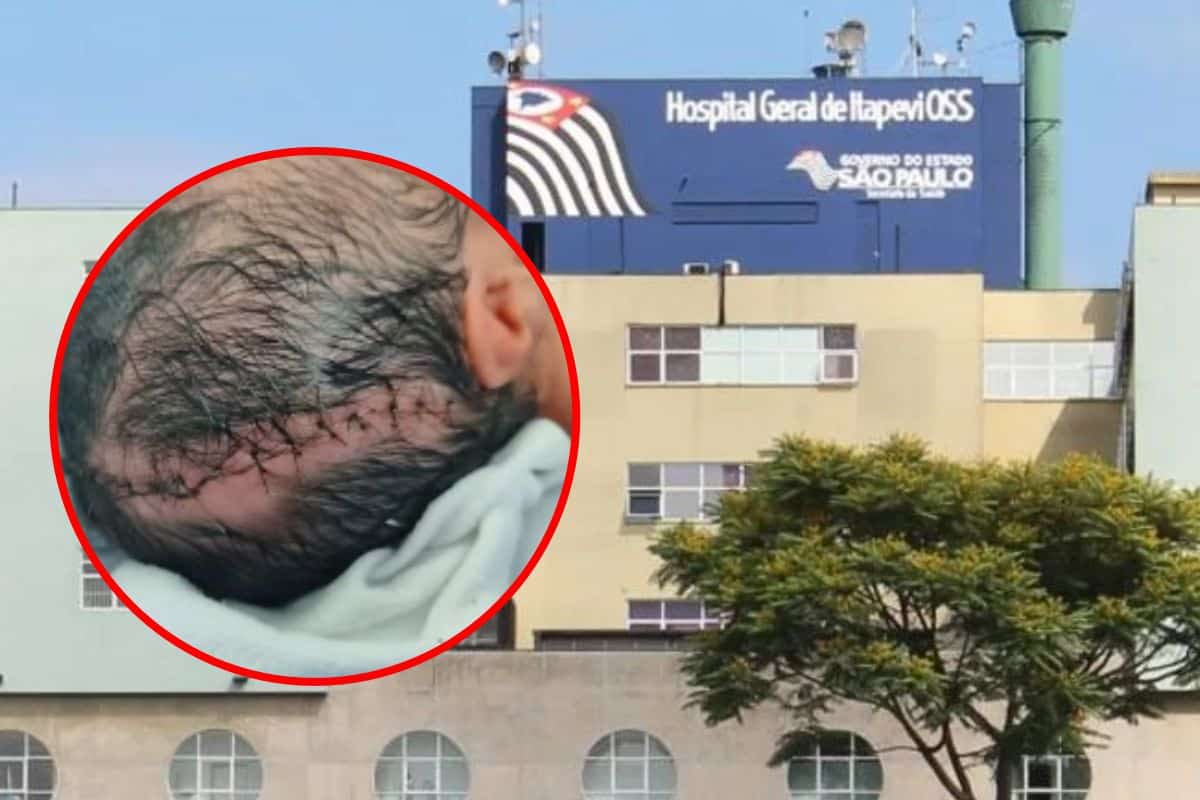 Bebê Nasce Com Corte Grave Na Cabeça Durante Parto Cesárea No Hospital Geral De Itapevi