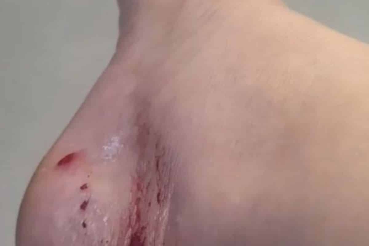 Moradora De Cabreuva E Mordida Por Cachorro E Upa Diz Que Ela So Pode Tomar Vacina Se O Cachorro Morrer