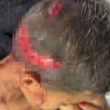 Criança De 6 Anos Fica Gravemente Ferida Em Ataque De Pitbull Em Mairinque