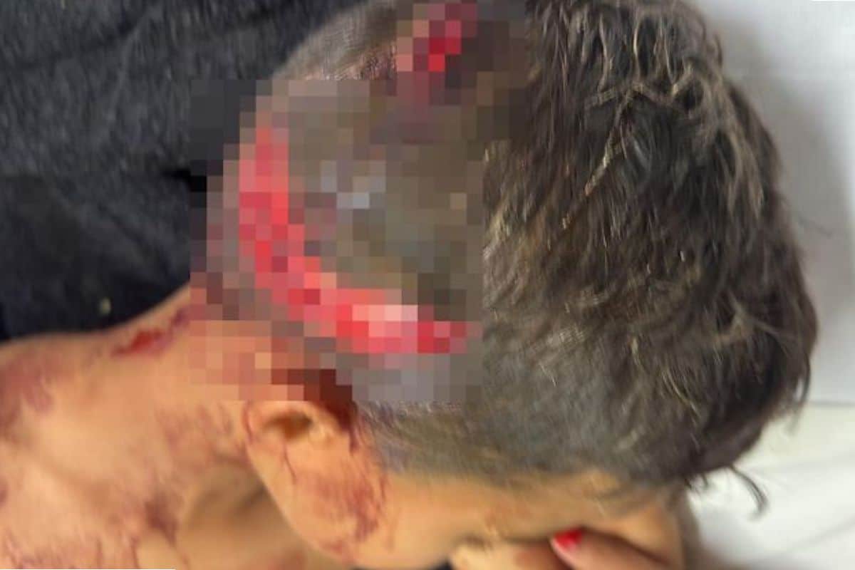 Criança De 6 Anos Fica Gravemente Ferida Em Ataque De Pitbull Em Mairinque