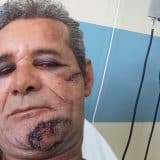 Homem Atacado Com Barra De Ferro Em Mairinque Realiza Cirurgias No Rosto