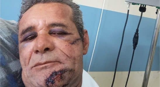 Homem Atacado Com Barra De Ferro Em Mairinque Realiza Cirurgias No Rosto