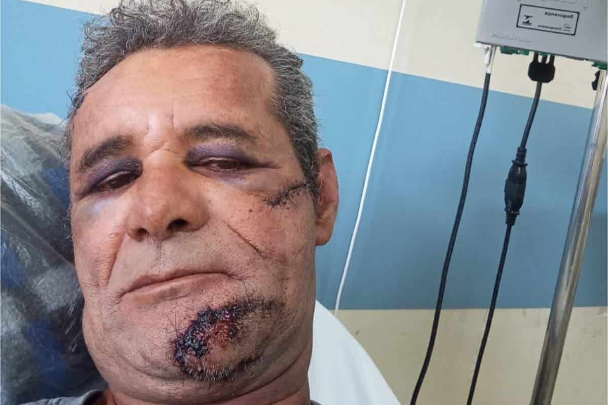 Homem Atacado Com Barra De Ferro Em Mairinque Realiza Cirurgias No Rosto