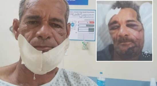 Homem Atacado Com Barra De Ferro No Rosto Após Sair De Bar Em Mairinque Deixa Hospital