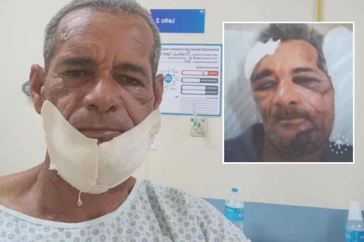 Homem Atacado Com Barra De Ferro No Rosto Após Sair De Bar Em Mairinque Deixa Hospital