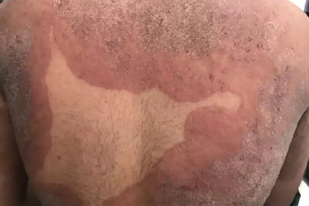 “Superfungo” Que Ataca A Virilha E Nádegas E É Resistente A Medicamentos E Causa Preocupação