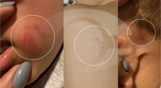 Família Denuncia Negligência Em Creche Em Mairinque Após Criança Ser Mordida