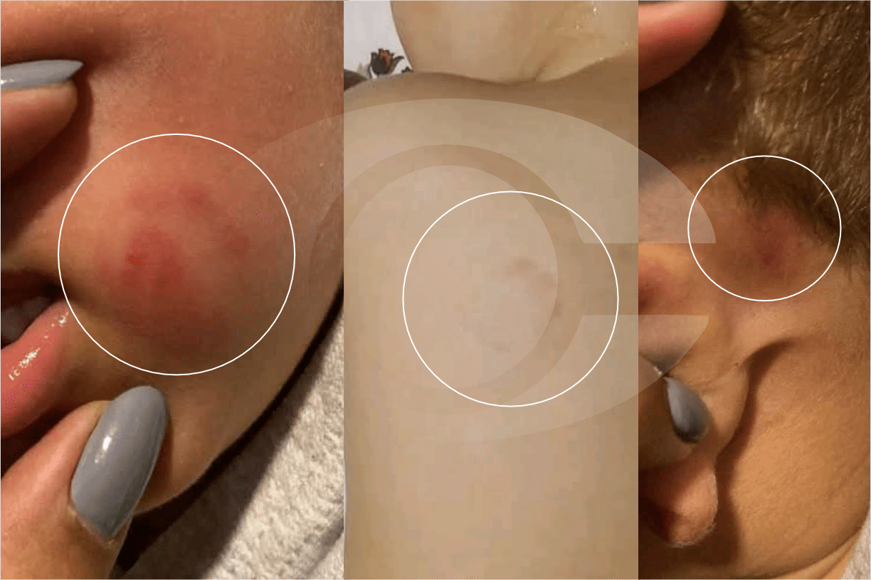 Família Denuncia Negligência Em Creche Em Mairinque Após Criança Ser Mordida