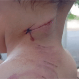 Gestante E Filho De 3 Anos São Atacados Por Cachorro Em Araçatuba