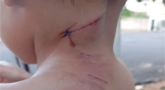 Gestante E Filho De 3 Anos São Atacados Por Cachorro Em Araçatuba