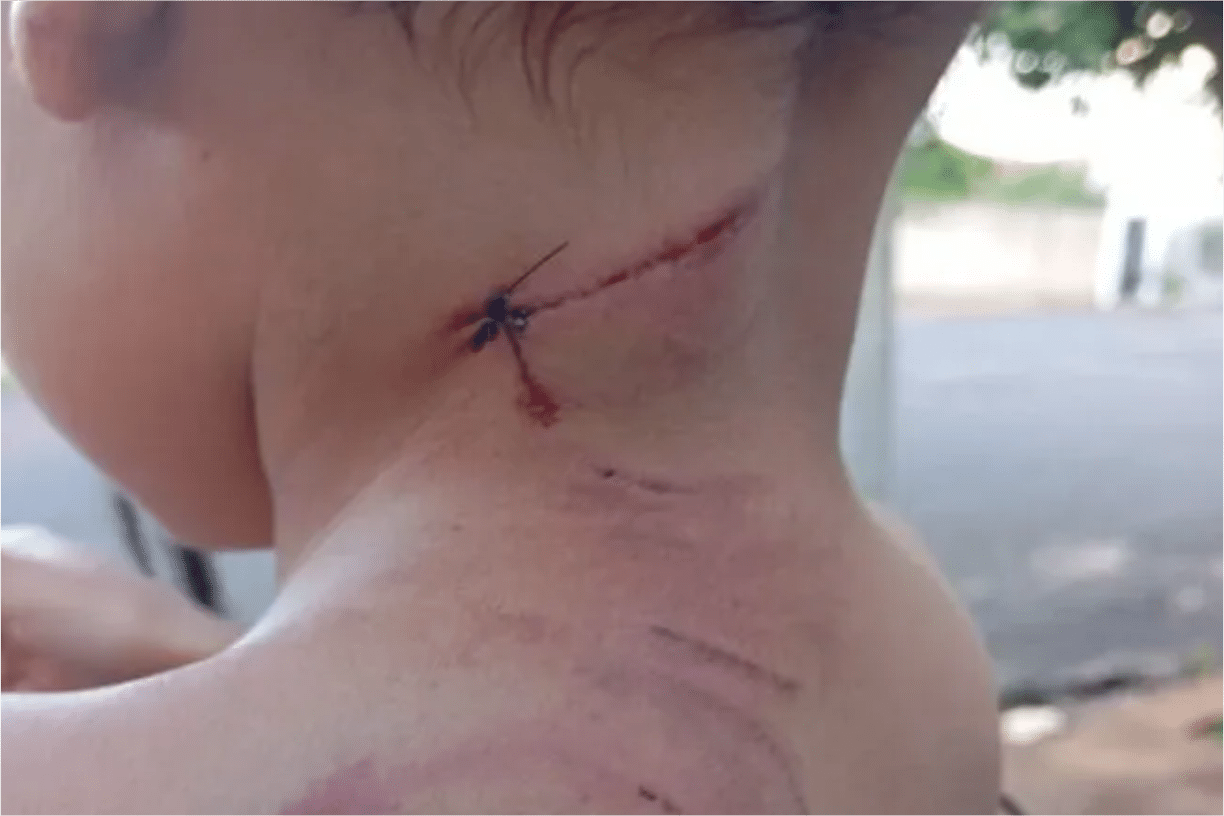 Gestante E Filho De 3 Anos São Atacados Por Cachorro Em Araçatuba