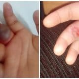 Criana Sofre Picada De Aranha Em Creche De Sorocab 1772625670873