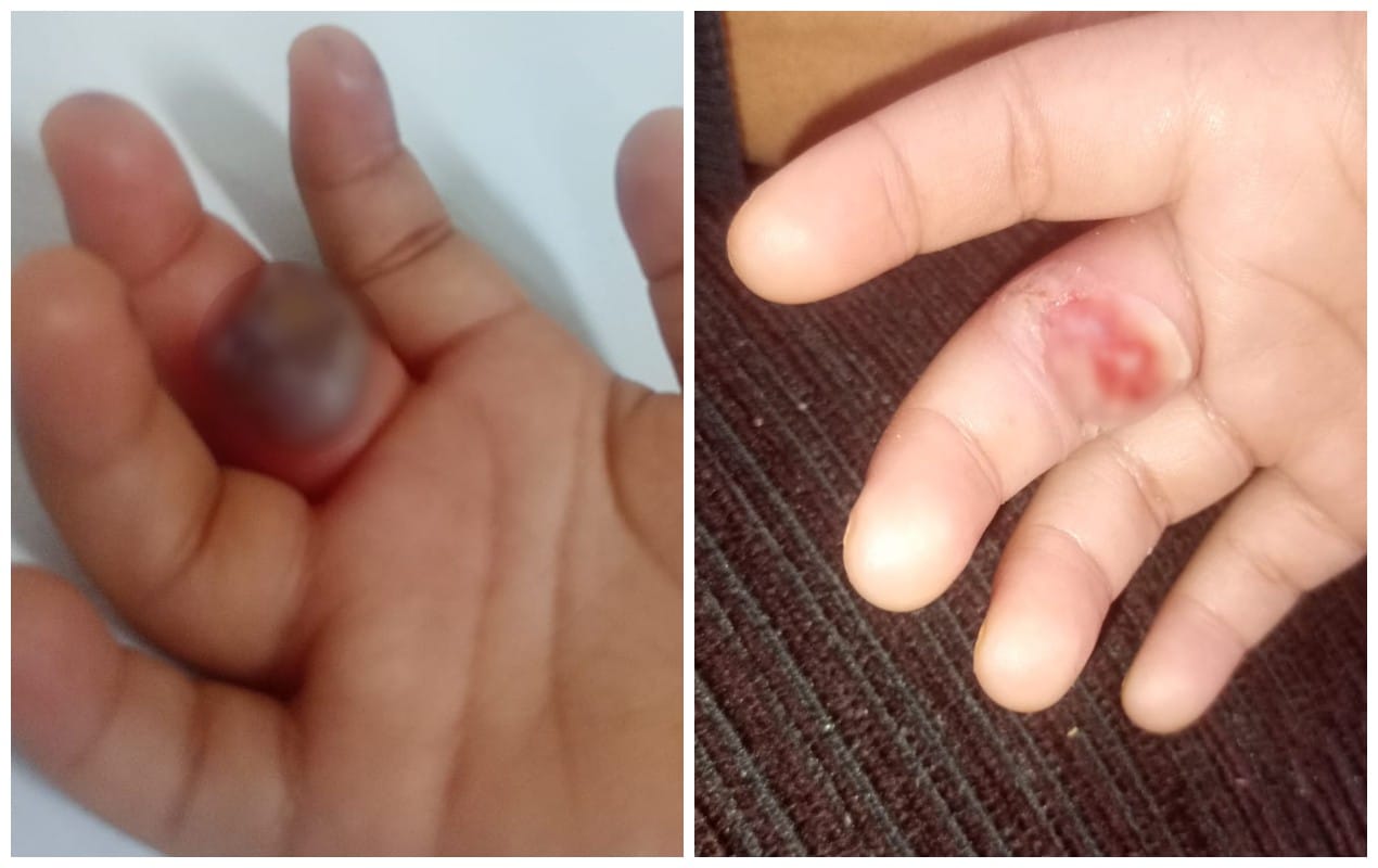 Criana Sofre Picada De Aranha Em Creche De Sorocab 1772625670873