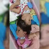 Gêmeas Siamesas De Ribeirão Preto Chegam À Reta Final De Cirurgias Para Separação Definitiva 1 Gmeas Siamesas De Ribeiro Preto Chegam Reta Final 1774115180302