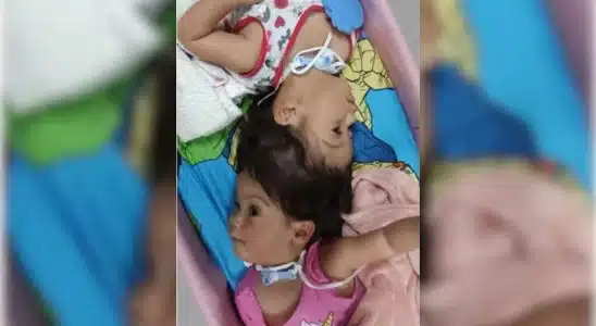 Gêmeas Siamesas De Ribeirão Preto Chegam À Reta Final De Cirurgias Para Separação Definitiva 2 Gmeas Siamesas De Ribeiro Preto Chegam Reta Final 1774115180302