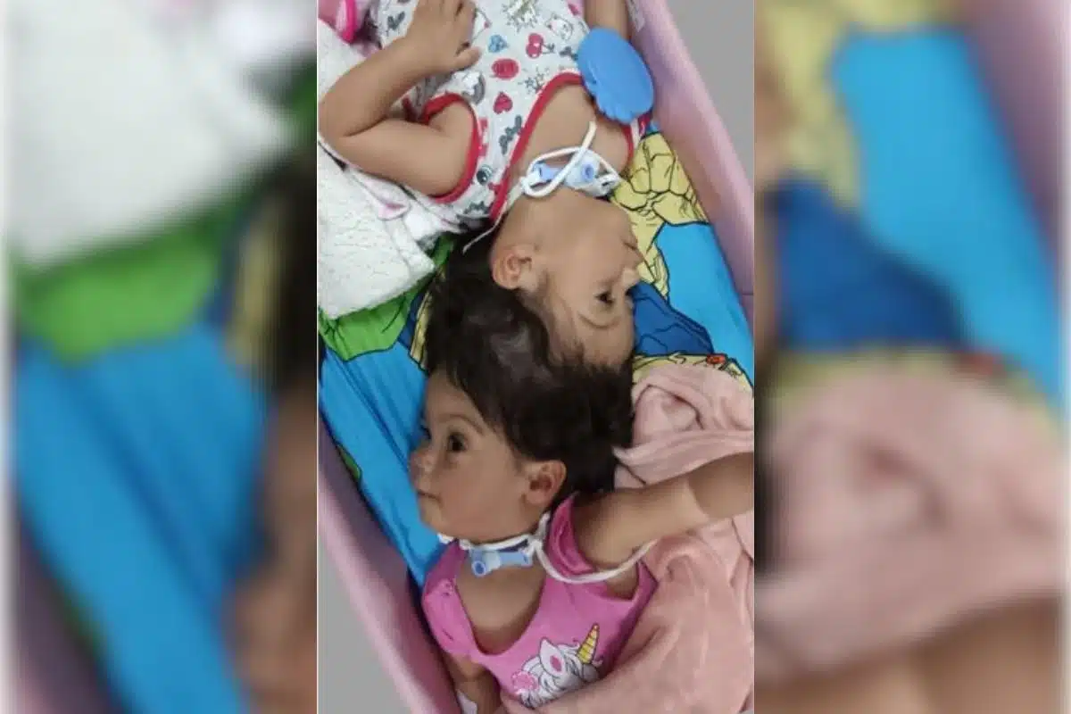 Gêmeas Siamesas De Ribeirão Preto Chegam À Reta Final De Cirurgias Para Separação Definitiva 7 Gmeas Siamesas De Ribeiro Preto Chegam Reta Final 1774115180302