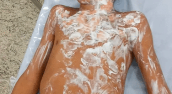 Criança De 7 Anos Sofre Queimaduras Graves Em Acidente Doméstico Com Óleo E Fogão
