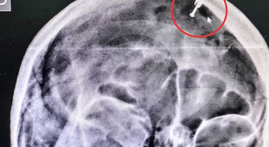 Homem É Preso Por Após Cravar Pino De Metal Na Cabeça Da Companheira Em Salto